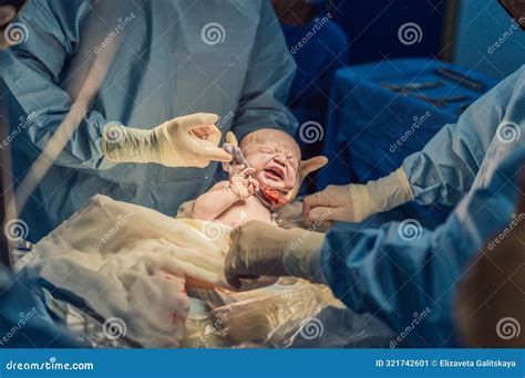 The Umbilical Cord is Visible Around the Neck of a Newborn Undergoing Cesarean Section. this ...