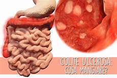 alimenti per colite ulcerosa colite ulcerosa e alimentazione apparato digerente alimenti per colite ulcerosa colite ulcerosa e alimentazione apparato digerente