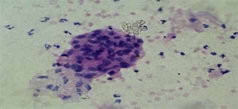 Tubercular pleural effusion with epithelioid cells– A rare cytological ...