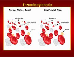 Image result for thrombocytopenic