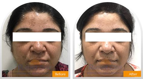 Before-After | Skin and Hair Treatment Results - Radiant Clinic