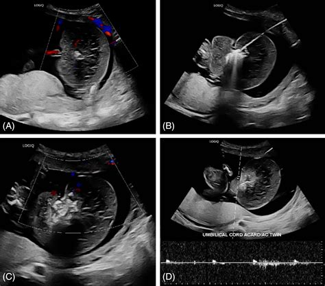 Management of twin reversed arterial perfusion (TRAP) sequence with ...