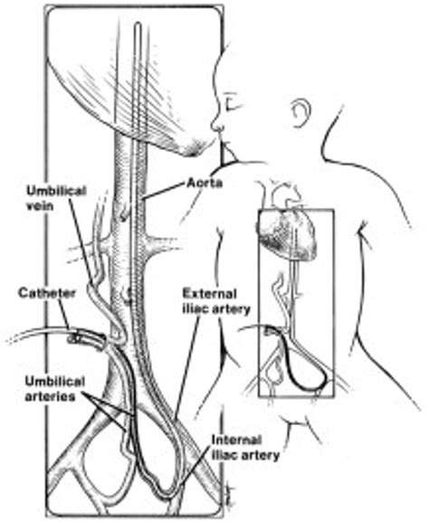 Infraumbilical surgical retrieval of transected umbilical artery ...