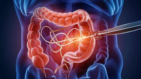 Image result for Loop Colonoscopy