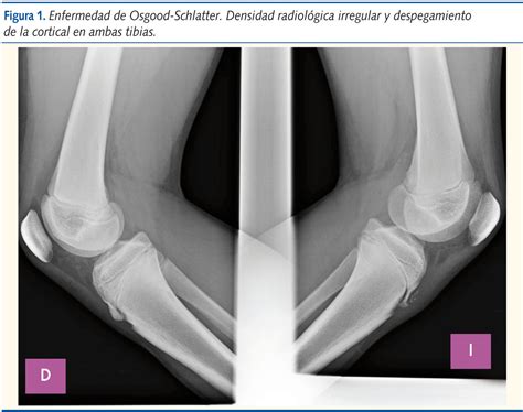 Revista de Pediatría de Atención Primaria - Enfermedad de Osgood ...