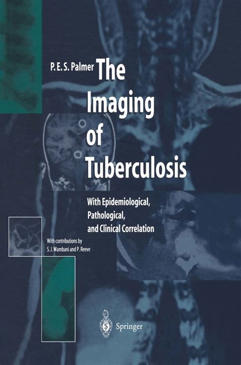 The Imaging of Tuberculosis With Epidemiological, Pathological, and ...