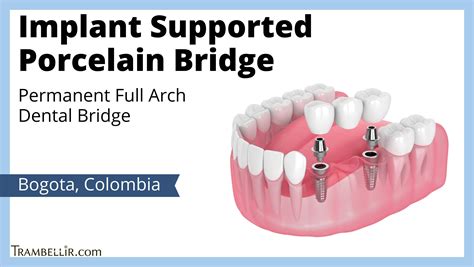 Implant Supported Bridge