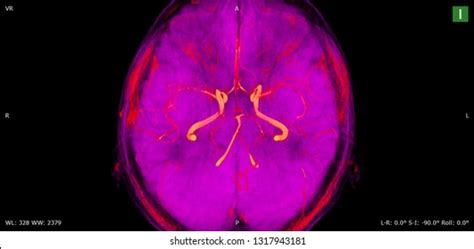 Image result for Maximum Intensity Projection Python