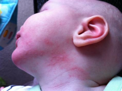 CMPA Baby and breastfeeding - Nomipalony