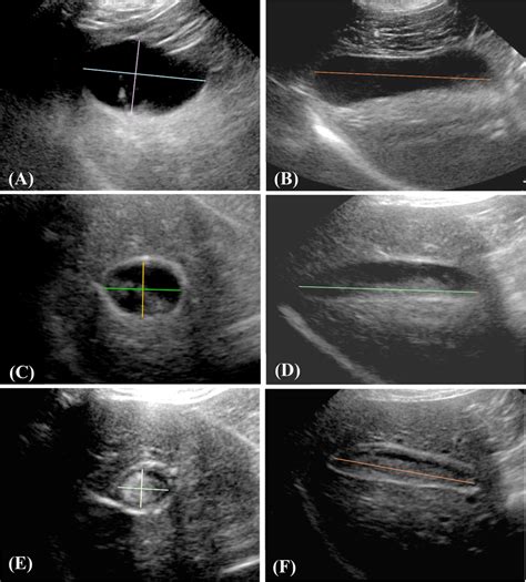 Image result for Gallbladder Test