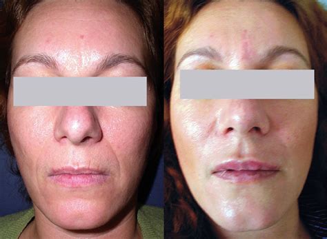 SpectraLift Non-Surgical Facelift - A Facelift Without Surgery! | Facelift without surgery, Non ...