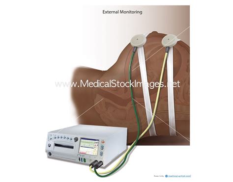 External Foetal (Fetal) Monitoring (African heritage) – Medical Stock Images Company