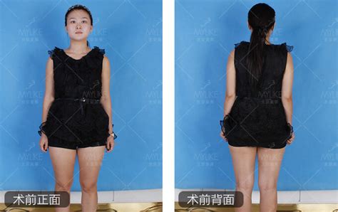 张梦+腿部吸脂减肥效果图前后对比+吸脂瘦腿案例_上海美莱整形医院