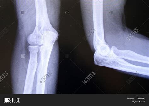 Elbow Joint X-Ray Image & Photo | Bigstock