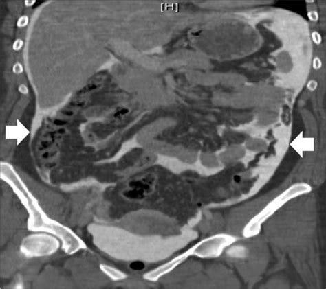 Image result for Intraperitoneal Therapy