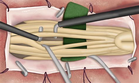 Selective dorsal rhizotomy: an illustrated review of operative techniques in: Journal of ...