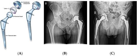 Osteoarthritis Hip Replacement