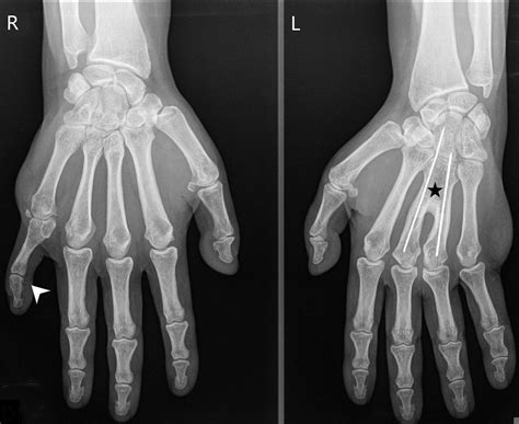 Solitary kidney in a patient with Pallister-Hall syndrome - Kidney ...