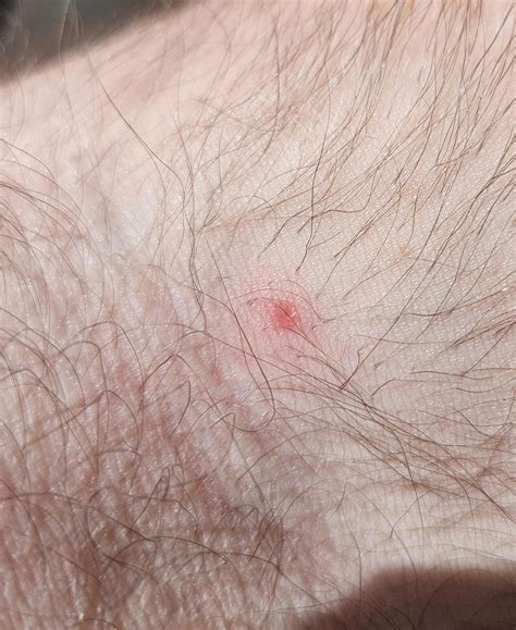 Image result for Exploding Elbow Pimple