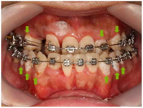 Fluorinated Bioactive Glass Nanoparticles: Enamel Demineralization ...