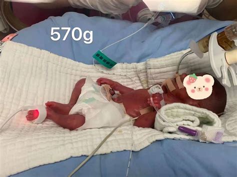 24周早产，仅570克！深圳超早产儿103天后顺利出院 |孕期保健|糖糕妈妈育儿网