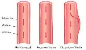 Even mild increase in systolic and diastolic BP tied with risk of ...