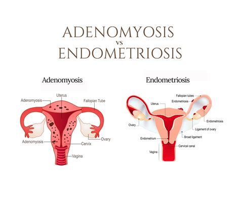 Difference between Endometriosis and Adenomyosis - Gynaecologist Kolkata