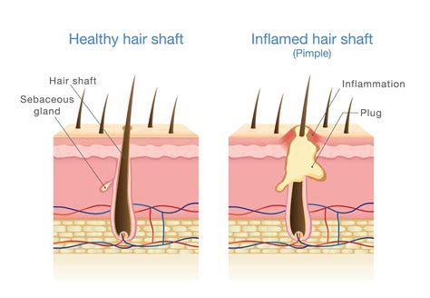 Inflamed Hair Follicles - Head/Scalp Folliculitis Treatment