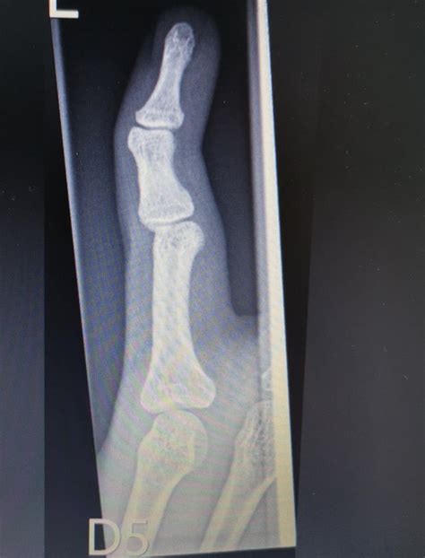 Saw the dislocated finger and thought I'd share some pics of my ...
