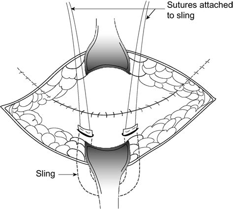 What Is A Sling For The Bladder at Gary Manuel blog