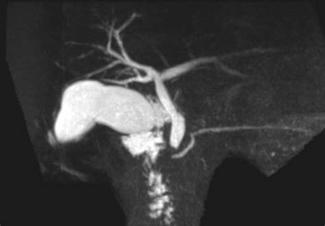 Image result for Abnormal MRCP