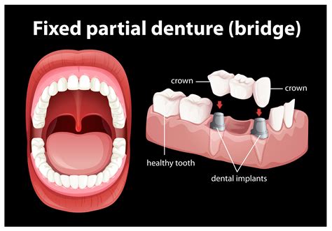 Fixed Partial Denture