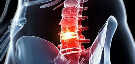 Image result for Via Disc Procedure