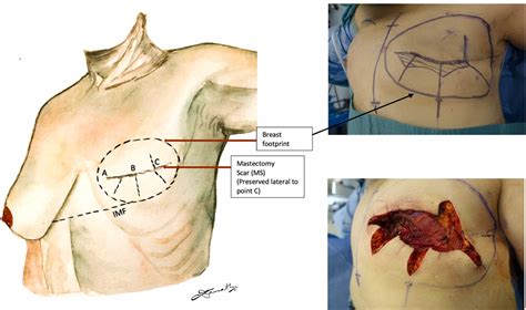 ‘Rosebud’ inset of DIEP flap in delayed breast reconstruction for consistent projection, lateral ...