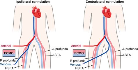 Hemodynamic considerations of ipsilateral versus contralateral ...