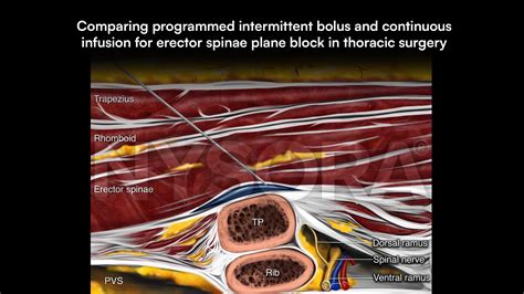 Comparing proximal and distal approaches for intercostobrachial nerve block in upper arm surgery ...