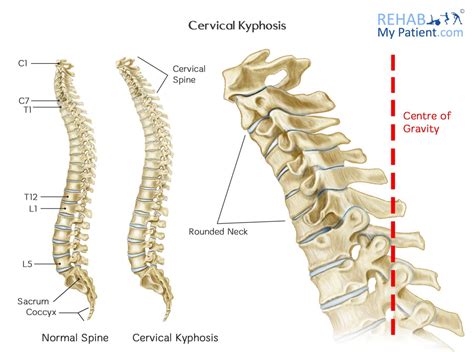 Lordosis Vs Kyphosis