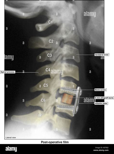Anterior cervical fusion hi-res stock photography and images - Alamy