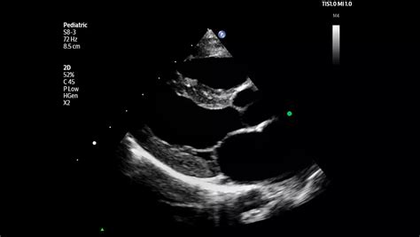 Philips-Flash-Ultrasound-System-5100-Point-of-Care-Pro