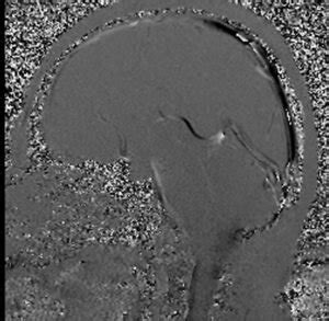 CSF Flow MRI 的图像结果