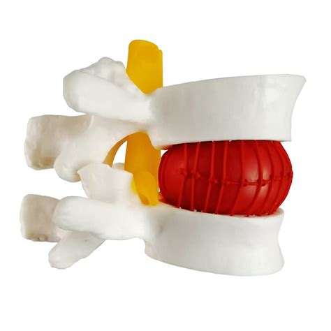 NEW HORIZON 2025 New Human Anatomical Lumbar Herniation Model, India | Ubuy