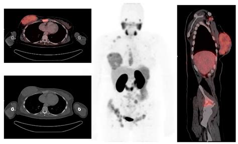 The Role of PET/CT in Breast Cancer
