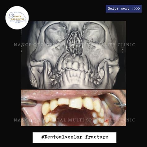 Jaw bone fracture