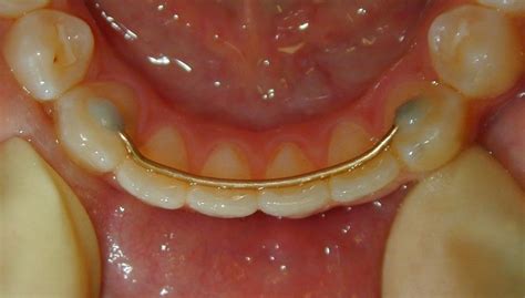 Image result for Retainer Problems