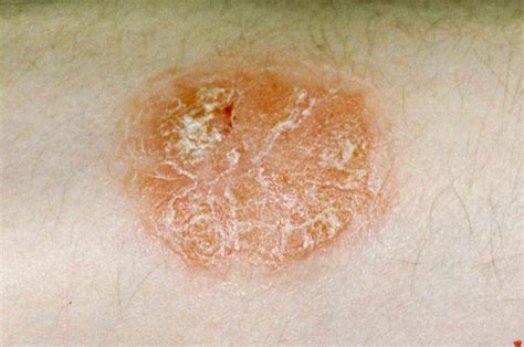 What Is Plaque Psoriasis And What Does It Look Like at Elijah Newton blog