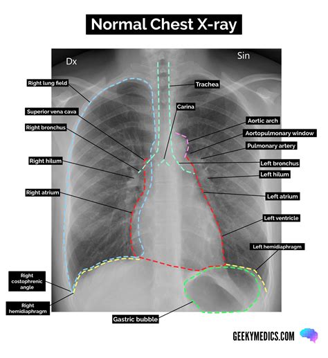 The Normal Chest X-ray | Normal CXR | Geeky Medics