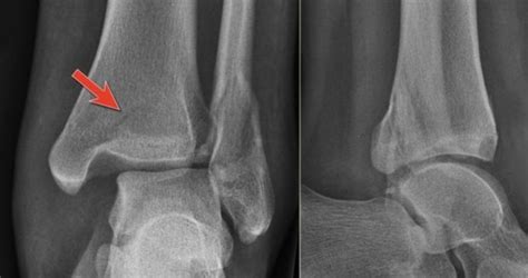 발목 골절(Fracture of ankle) : 발목이 비틀리면서 발목 뼈가 부러졌어요 : 네이버 블로그