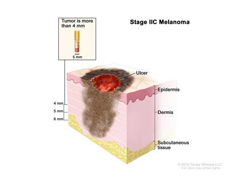 Melanoma | Surgical Innovations