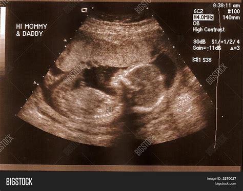 18 Weeks Embryo
