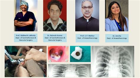 BHU doctors successfully remove 25 paise coin stuck in man's trachea ...